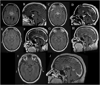 Practical application of precision oncology in adult onset craniopharyngiomas